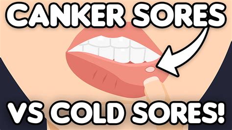 Cold Sores Vs Canker Sores Youtube