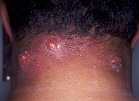 Carbuncle Pictures Symptoms Causes Treatment And Removal