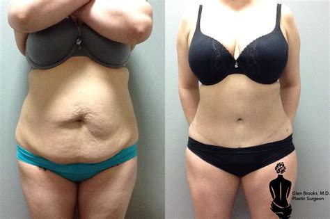 Abdominoplasty Before And After Photos Patient 97 Springfield Ma