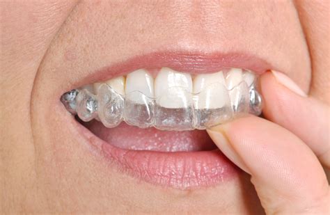 How to brush your teeth with braces. Why our Clear Braces are faster than Invisalign!