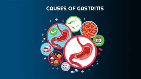 Gastritis Causes Treatment And Diagnosis Nutritionfact In