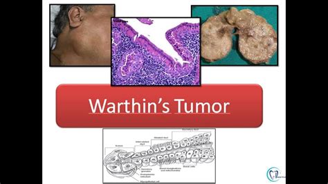 Warthins Tumor Youtube