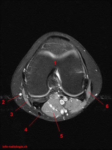 When positioning unilateral axial slices for the hip, a coronal image can be used to ensure inclusion of all. Atlas of Knee MRI Anatomy - W-Radiology