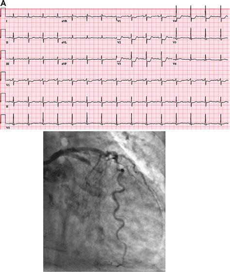 Ecg Of Isolated Posterior Mi Download Scientific Diagram