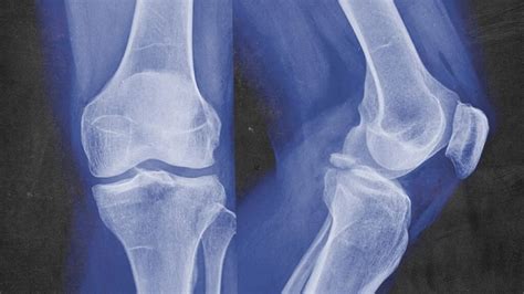 Avulsion Fracture Treatment Types Recovery Time And Causes