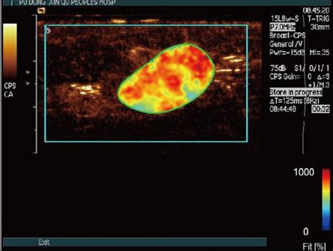 in a 68 year old woman with a palpable mass in the outer upper quadrant download scientific