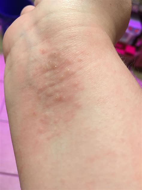 Allergy Bumps On Arm My Xxx Hot Girl