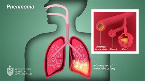 Pneumonia Symptoms Causes Treatment Santripty