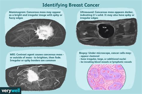 What Does Breast Cancer Look Like On An Ultrasound