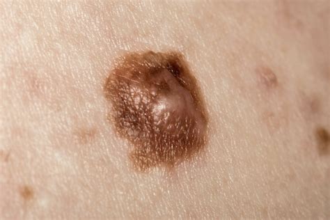 What Skin Cancer Looks Like A Blister Signs You Have Skin Cancer