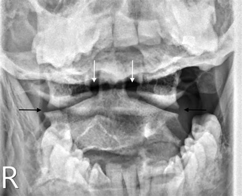 Cervical Spine Radiology Anaesthesia And Intensive Care Medicine