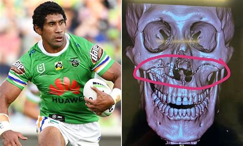 Nrl Star Who Suffered Gruesome Facial Injuries In Head Clash Reveals He