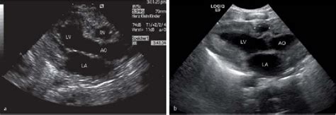 A Hypoplastic Right Heart In A Neonate With Pulmonary Atresia With