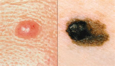 The Abcdes Of Moles And Melanomas Cancer Network
