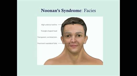 Noonan Syndrome Pictures Of Adults