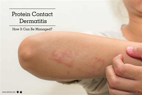 Protein Contact Dermatitis How It Can Be Managed By Dr Sumit