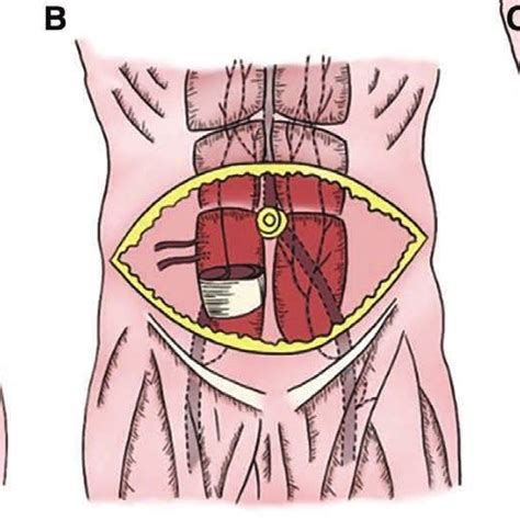 Segmental Defect In Rectus Abdominis Muscle Is Evident Within The