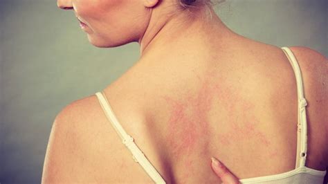 Dermatite Da Sudore Come Prevenirla E Curarla Rimedi E Salute