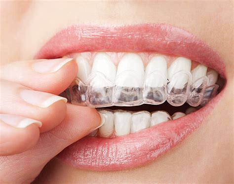 Professional Teeth Whitening Step By Step Guide By A Dentist Capstone Dental