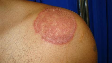 Pics Photos Tinea Ringworm