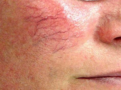 Facial Veins Cyprus Dermatology Clinic