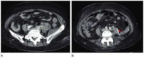 Contrast Enhanced Ct Scan Demonstrating Multilocular Abscess With