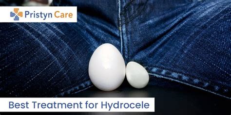 Best Treatment For Hydrocele Pristyn Care