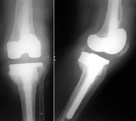 Radiographs In Anteroposterior And Lateral Views Of The Left Knee