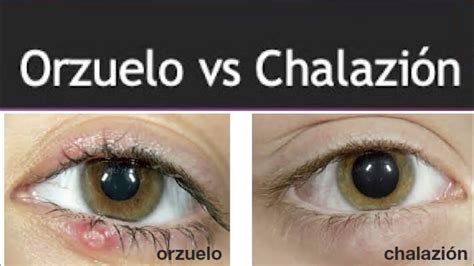 Orzuelo Y Chalazión Una Rápida Revisión En Sus Diferencias Youtube