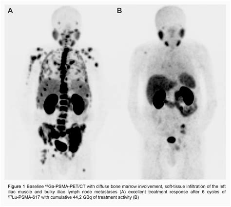 Radioligand Therapy With 177lu Psma 617 In Patients With Diffuse Bone