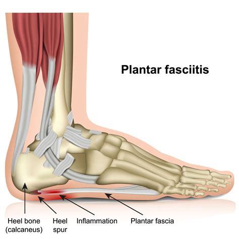 Plantar Fasciitis Ankle And Foot Centers Of Georgia West Cobb