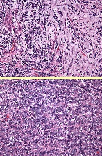 Myoepithelial Tumours Of Skin And Soft Tissue An Update Diagnostic