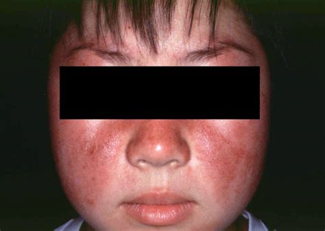 Image Systemic Lupus Erythematosus Malar Rash Msd Manual