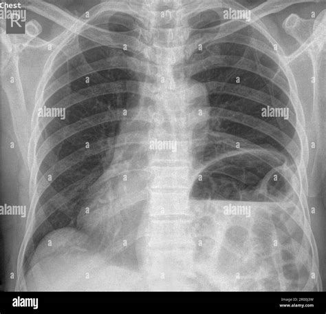 Hiatus Hernia X Ray Stock Photo Alamy