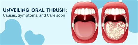 Unveiling Oral Thrush Causes Symptoms And Care Unicorn Denmart Top Dental Equipment