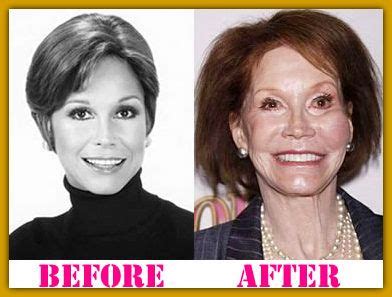 Joyce Meyer Bad Plastic Surgery Mary Tyler Moore Places To Visit Bad Celebrity Plastic