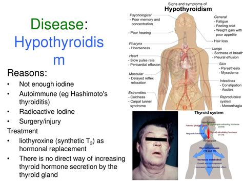 Ppt Disease Hypothyroidism Powerpoint Presentation Free Download