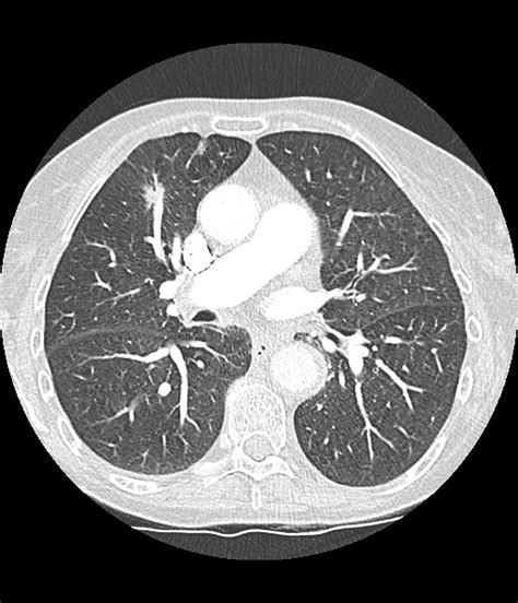 What To Do With Lung Nodules Pulse Today