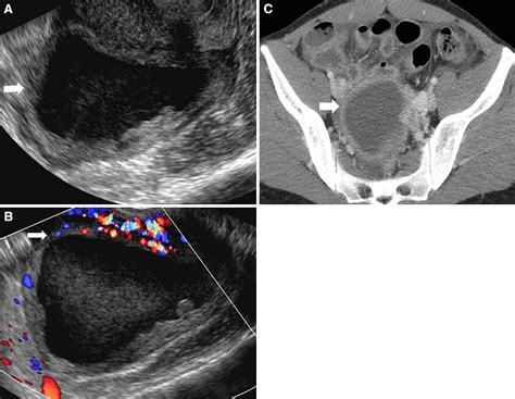 Radiological Appearances Of Corpus Luteum Cysts And Their Imaging