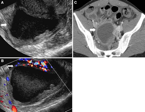 radiological appearances of corpus luteum cysts and their imaging mimics semantic scholar