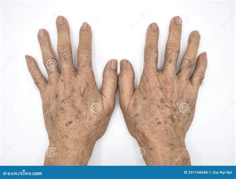 Age Spots On Hands Of Asian Man They Are Brown Gray Or Black Spots