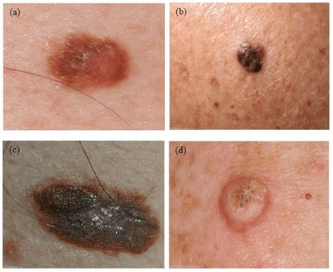 Different Types Of Keratosis Skin Lesions
