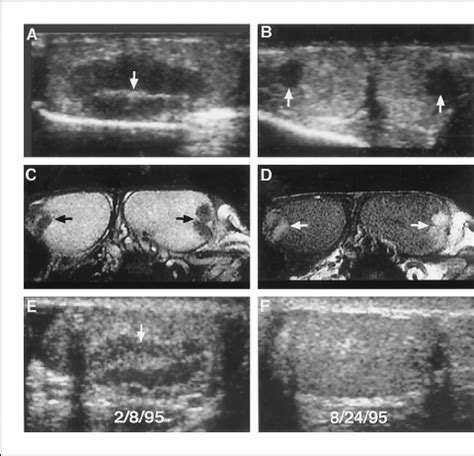 Characteristic Radiologic Features Of Testicular Adrenal Rest Tumors