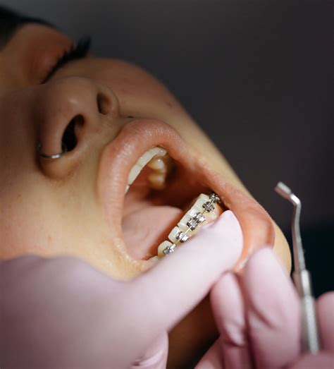 Do Braces Fix Overbites Burke And Beckstrom Orthodontics