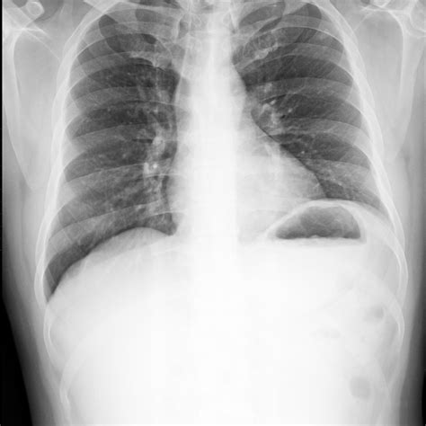 Benign Lung Nodules Identified Using Proteomic Biomarker Pulmonology