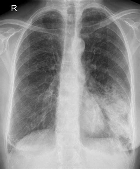 Chest X Ray Interpretation In Patients Cough A Week Radiology Imaging