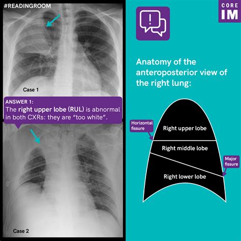 Atelectasis Chest X Ray