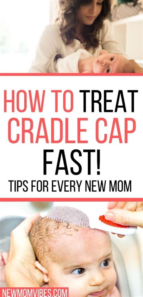 How To Get Rid Of Cradle Cap Natural Home Remedies New Mom Vibes