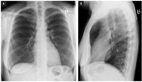 63 Year Old Male Patient With A Persistent Cough Chest X Ray