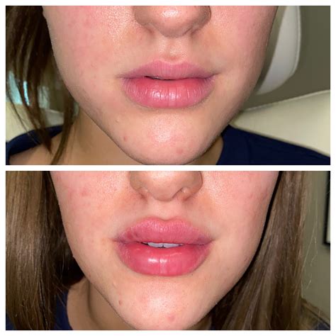 Dermal Filler Before And After Onyx Integrative Medicine And Aesthetics